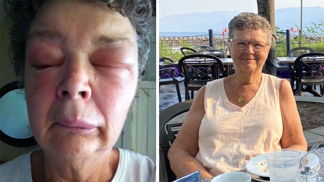 Wendy Barto shown before and after adopting a whole food plant based diet and healing from idiopathic angioedema: on the left, a close-up of her face with swollen eyelids, on the right, she sits outside at a cafe smiling, with no swelling